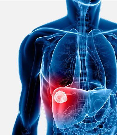 Cancer Diagnostics